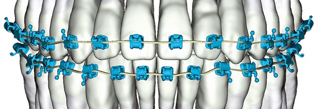 digital braces