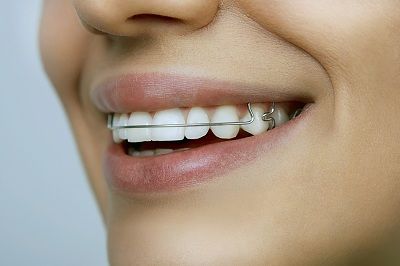 metal retainer