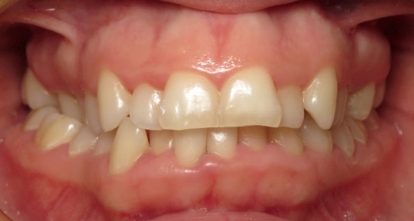 LY15-Initial-Examantocclusal-1 LY15-Initial-Examantocclusal-1